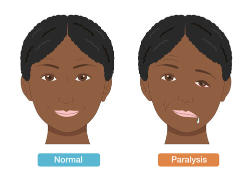 Anatomical Illustration Comparing Facial Asymmetry and Symptoms Caused by Facial Nerve Palsy