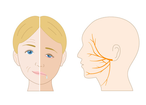Anatomical Illustration Comparing Facial Asymmetry and the Facial Nerve Pathway Caused by Facial Nerve Palsy