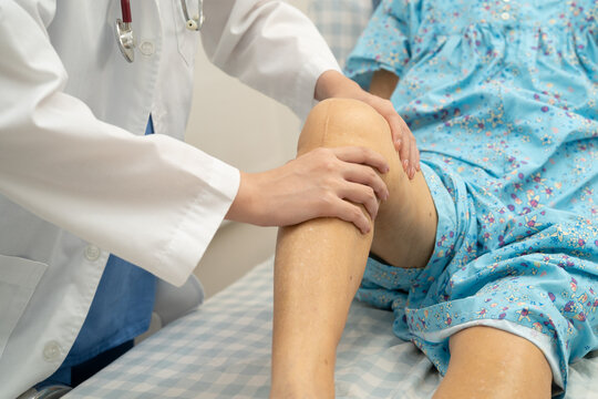 Doctor checking Asian elderly woman patient knee replacement surgery in hospital.