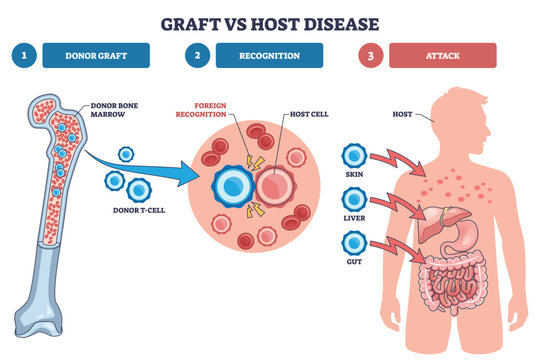 Graft vs host disease concept shows donor bone marrow and T cells recognize a host cell, then attack skin, liver, and gut in staged steps. Outline diagram