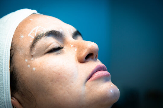 Close-up of woman's face with mapping marks for aesthetic procedure