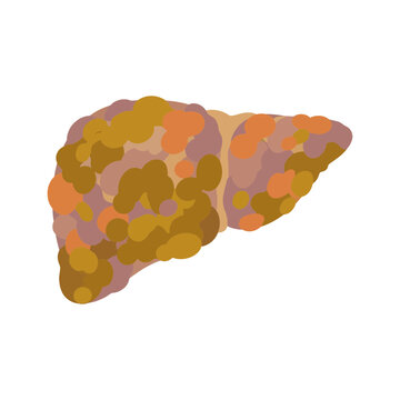 Anatomical Illustration of a Diseased Human Liver with Cirrhosis and Tissue Damage