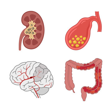 Set of Anatomical Illustrations Featuring Human Internal Organs with Medical Conditions and Pathologies