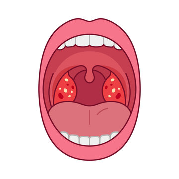 Medical illustration of an open human mouth showing tonsillitis with white pus spots on red tonsils