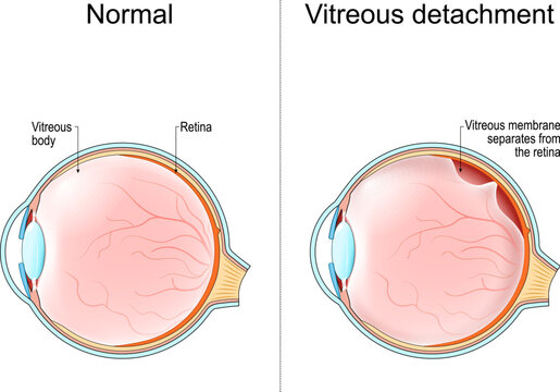 Posterior vitreous detachment PVD. Cross section of human eye