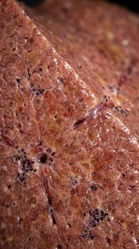 Fibrotic liver structure: hepatic damage, disease state, hepatitis manifestation, cell degeneration, organ impairment, tissue inflammation, medical condition.