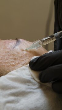 Injections of skin-lifting treatments. Mesotherapy. Close-up of female face during youth restoration and facial rejuvenation procedure - Vertical Video