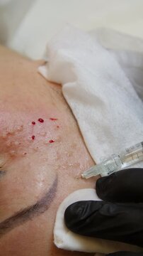 Injections of skin-lifting treatments. Mesotherapy. Close-up of female face during youth restoration and facial rejuvenation procedure - Vertical Video