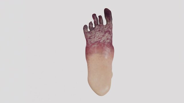 Back side of Foot tissue necrosis involving loss of viable tissue associated with impaired circulation infection and severe vascular conditions in 4K UHD video