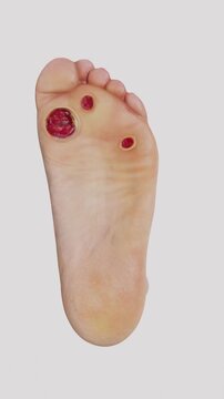 Diabetic foot refers to foot complications associated with diabetes, including nerve damage, reduced circulation, skin changes, ulcers, and diabetic foot necrosis in vertical video