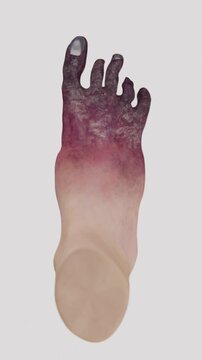 Front side of Foot tissue necrosis involving loss of viable tissue associated with impaired circulation infection and severe vascular conditions in vertical video