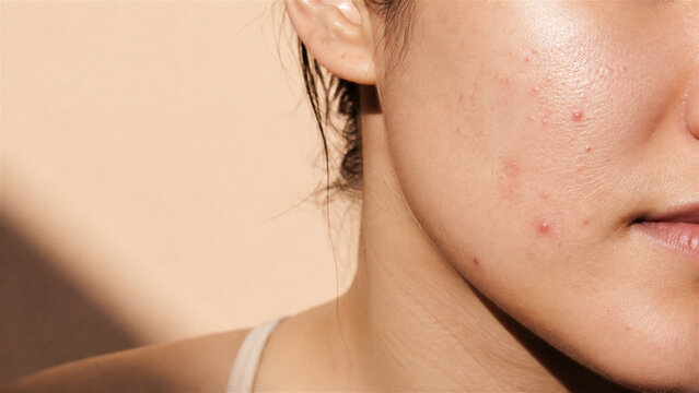 closeup of woman facial skin with acne and inflamed blemishes. Dermatology, skincare, adolescent health, and beauty treatment concept with copy space