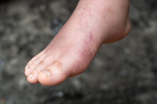 Swollen Foot After Cast Removal of Metatarsal Fracture