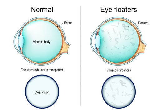 Posterior vitreous detachment PVD. Cross section of human eye