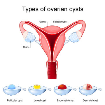 Types of ovarian cysts. Ovarian cyst comparison. Endometrioma, Dermoid, Luteal and Follicular cyst