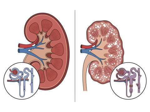 Human kidney with nephrostomy tube insertion diagram Vector