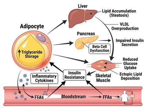 Insulin resistance and metabolic dysfunction diagram Vector