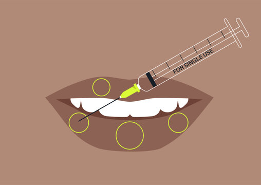 A detailed scheme illustrates the application of beauty fillers on lips, highlighting areas for enhancement, The softer, fuller look transforms the lips into an ideal beauty standard.