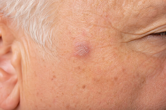 Actinic Keratosis on Sun-Damaged Facial Skin