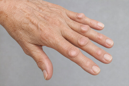 Heberden's Nodes on the Distal Interphalangeal Joints