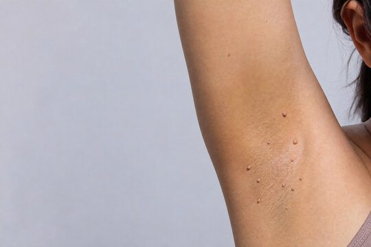 Skin Tags in the Axilla with Copy Space