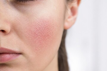 Fototapeta premium Irritated skin with redness and dryness on woman's cheek