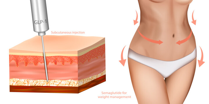 Medical illustration showing semaglutide GLP-1 therapy for weight management and obesity treatment. Subcutaneous injection into adipose tissue with female body. 
