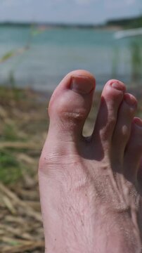 A close-up view of a painful skin blister on a human big toe with a blurred lake and beach in the background. The irritated skin is raised and swollen from friction on a sunny summer day.