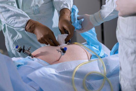 Surgeon is treating sites where laparoscopic trocars are inserted into abdominal cavity with gauze. Metal trocars have been inserted into patients skin. Medical team is wearing sterile white gowns