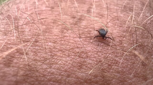 Tick crawls on a man's hand. Tick crawling along a person's hand. Encephalitis mite. Tick-borne encephalitis (TBE) is a viral infection spread by tick bites. Fatal diseases from tick bites