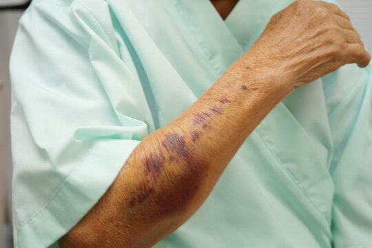 Ecchymosis, elderly bleeding on her arm after taking aspirin.