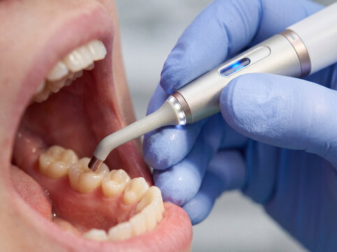 Dental Crown Placement Procedure for Molar Tooth Restoration in Professional Restorative and Prosthodontic Dentistry