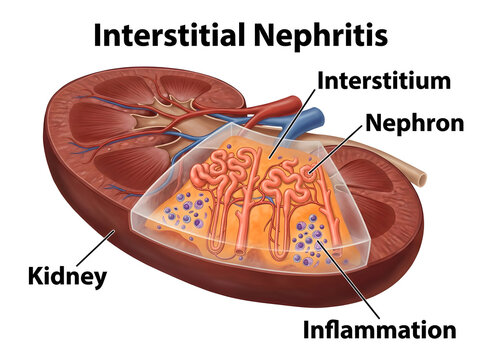 Interstitial nephritis kidney inflammation illustration isolated on white background