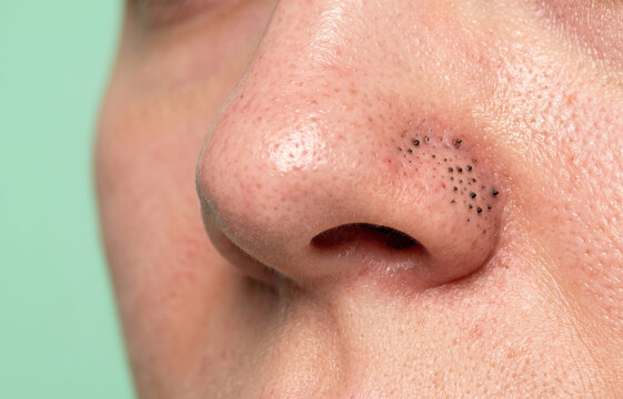 Close-up of a human nose with prominent blackheads, clogged pores, and oily skin, highlighting dermatological issues.