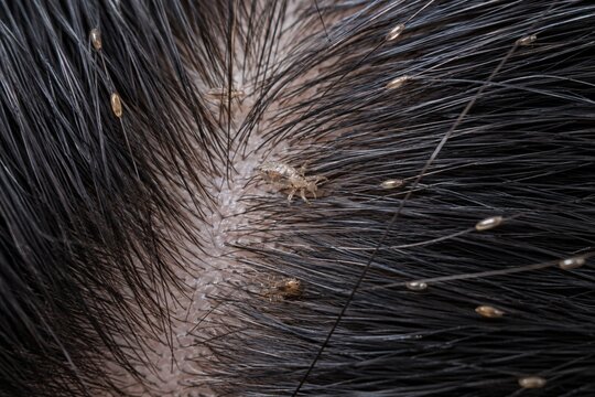 Head Lice and Nits on Human Hair and Scalp Close Up