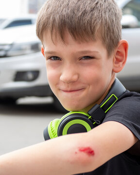 Selective focus Boy with a fresh wound on his arm, blood on his elbow. The man injured his arm during fall and smile.