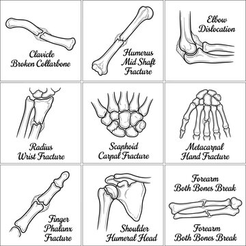 Medical illustrations of common bone fractures and dislocations  