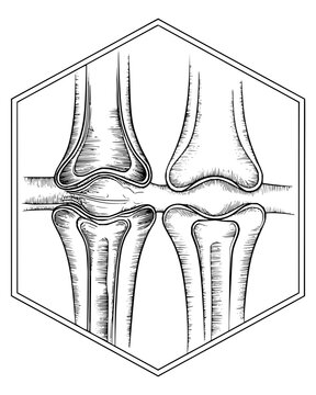 Comparative medical diagram showing a healthy joint versus a joint with degenerative wear and inflammation presented in a clean line art style inside a hexagon