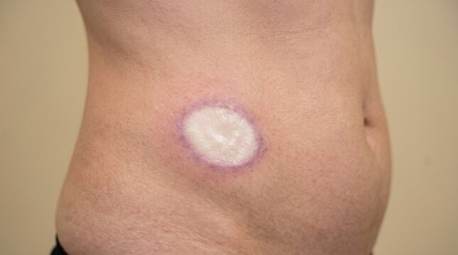 Close-up of Circular Morphea Scleroderma Plaque Scar on Patient Flank Skin