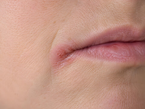 Close up of cracked, red inflammation at the corner of the mouth, indicating angular cheilitis or a cold sore.