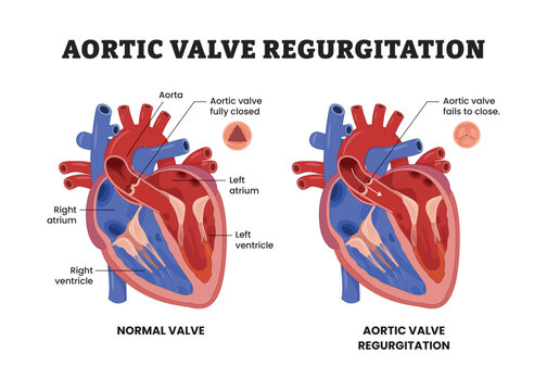 Aortic Valve Regurgitation labeled diagram, educational medical poster design healthcare scheme, valvular heart disease, aortic insufficiency, blood flow disorder. Normal valve and regurgitant valve