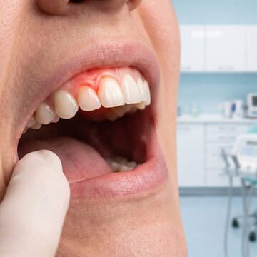 Close-up View of a Patient Undergoing a Dental Examination for Receding Gums and Periodontal Health Assessment in a Professional Clinic Setting