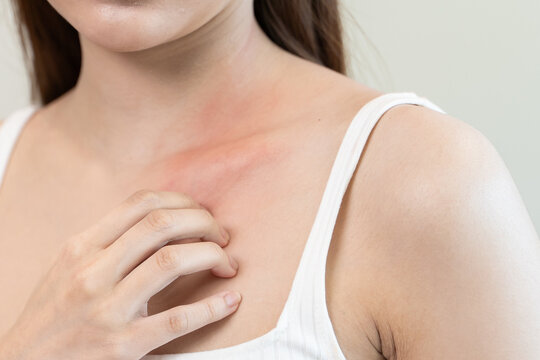 Sensitive skin allergic concept, Woman itching on her chest have a red rash from allergy symptom and from scratching.