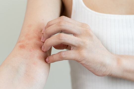Sensitive skin allergic concept, Woman itching on her arm have a red rash from allergy symptom and from scratching.