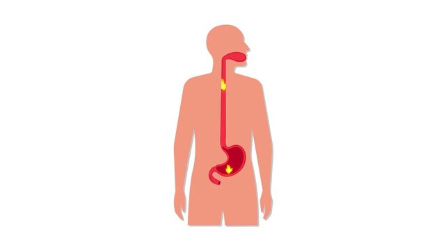 stomach burning pain acid reflux heartburn digestive problem animation
