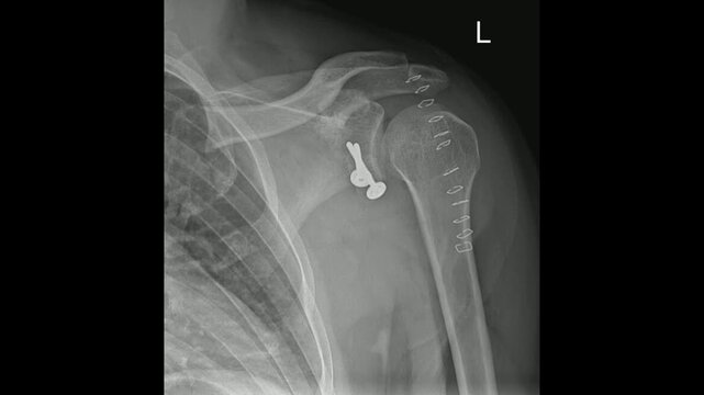 Postoperative X-ray of Left Shoulder Showing Surgical Fixation Hardware in Shoulder joint