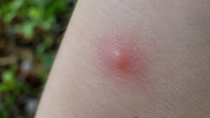 Fototapeta premium Close-up of a mosquito bite red swollen mark on a human arm with blurred green nature background