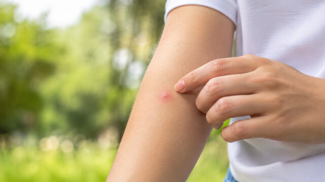 Person scratching a red mosquito bite mark on their arm outdoors with blurred green park background