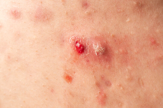 Skin abscess with abscess drainage. Boil and pus on infected skin. Medical dermatology macro with skin abscess. Abscess infection and visible drainage.