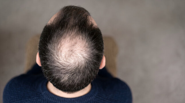 Top View of Man with Thinning Hair on Crown